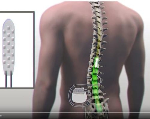 Paraplégico volta a andar com a ajuda de implante elétrico