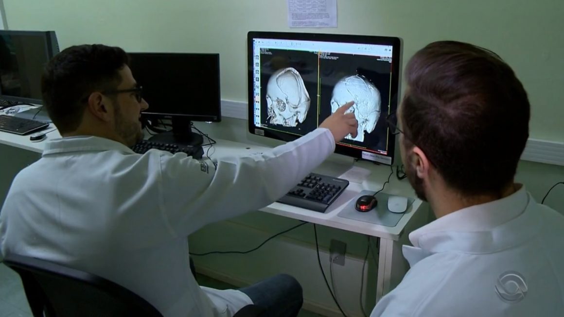 Médicos usam impressora 3D para reconstituir o crânio de um paciente em Santa Maria