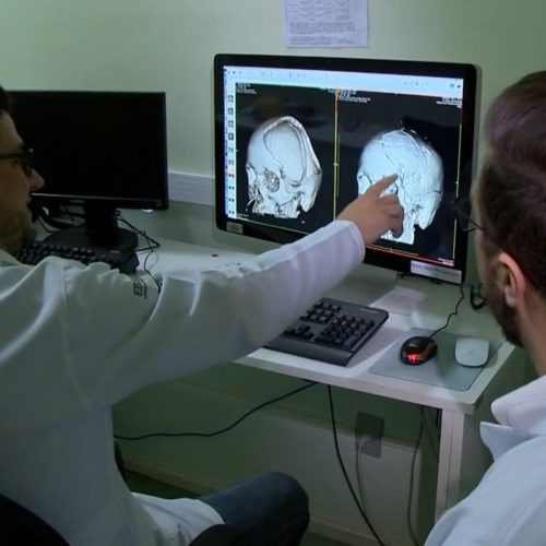 Médicos usam impressora 3D para reconstituir o crânio de um paciente em Santa Maria