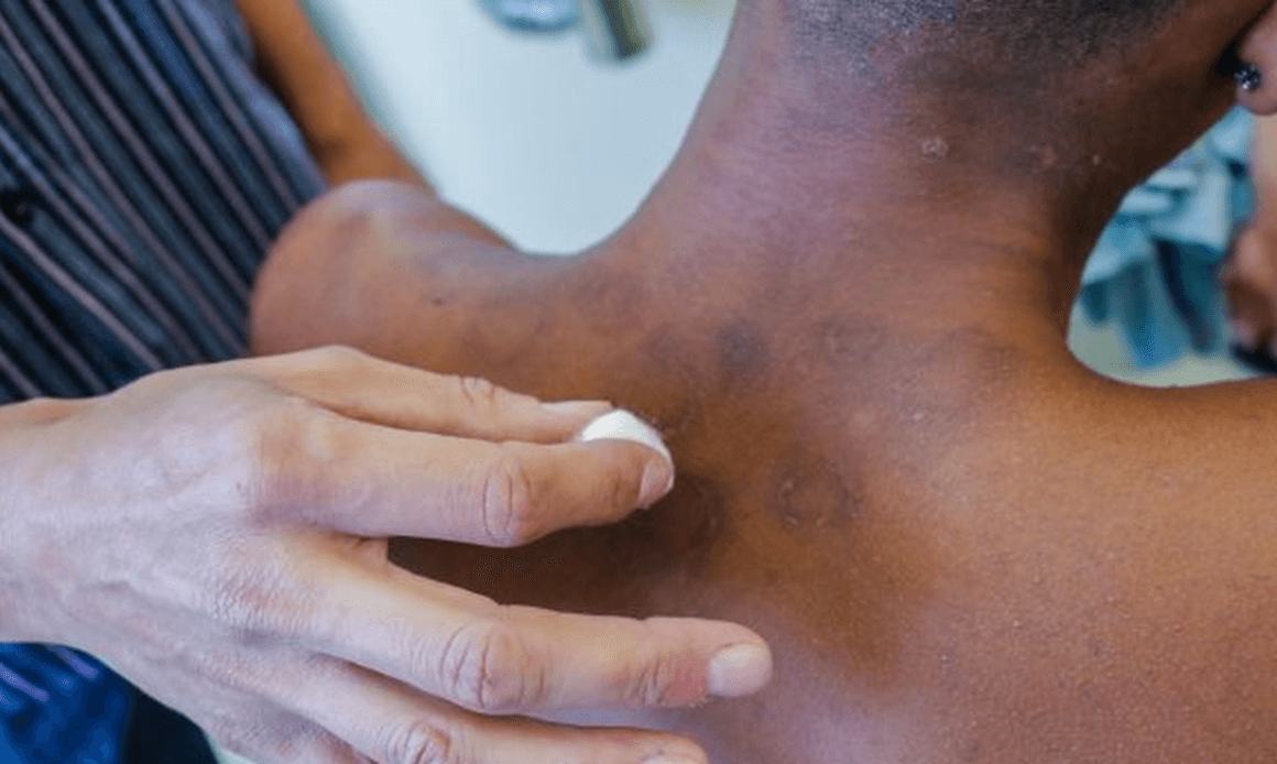 Janeiro Roxo alerta para a conscientização sobre a hanseníase – A doença tem cura e o tratamento é gratuito pelo SUS