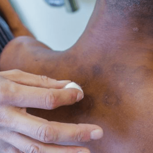 Janeiro Roxo alerta para a conscientização sobre a hanseníase – A doença tem cura e o tratamento é gratuito pelo SUS